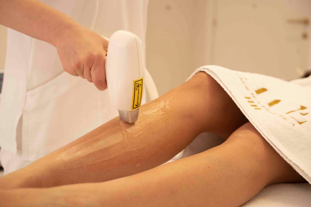 Epilazione laser al diodo